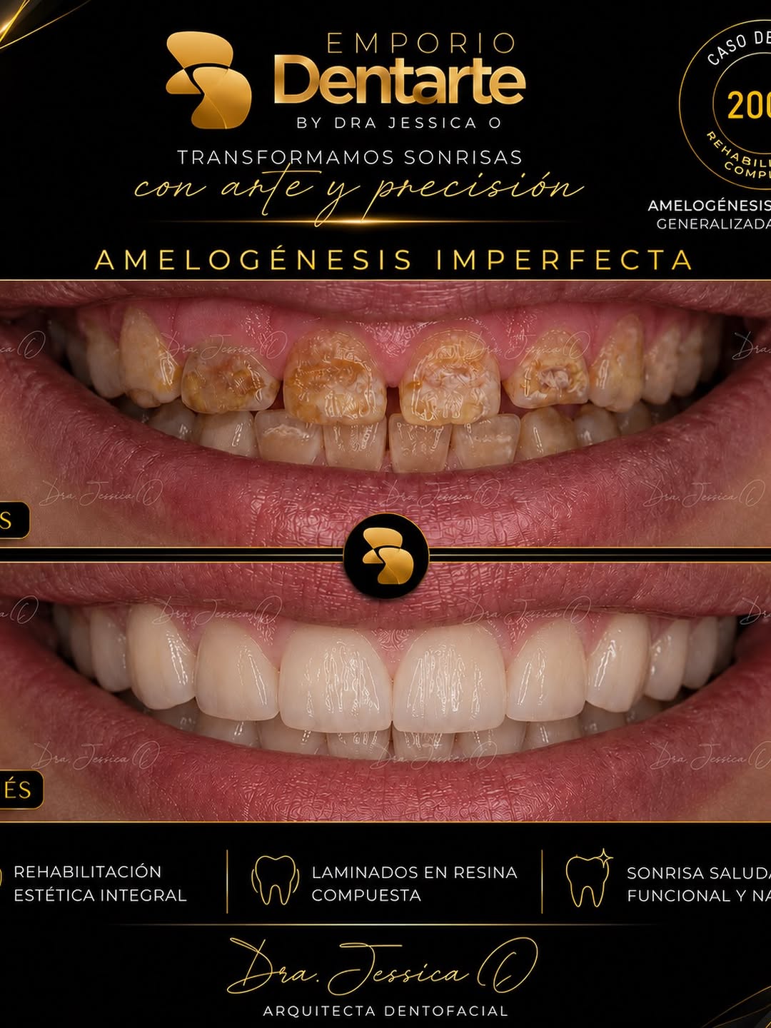 Caso clínico: Amelogénesis imperfecta