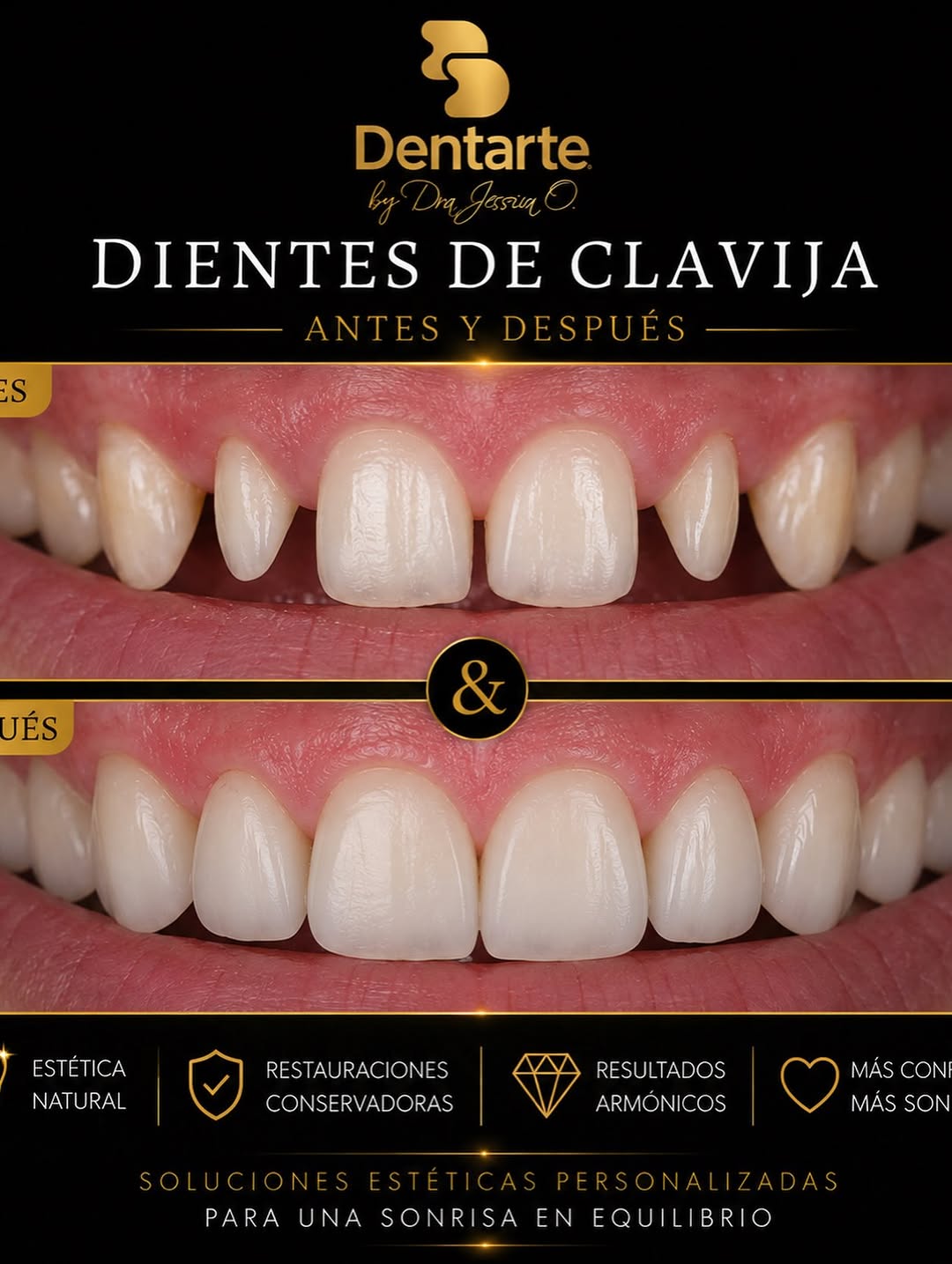 Caso clínico: Dientes de clavija