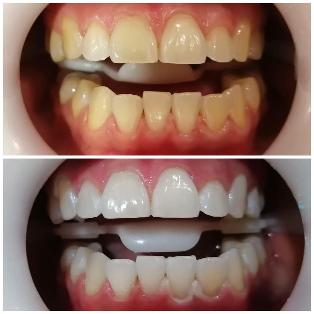 Blanqueamiento en clínica en Emporio Dentarte
