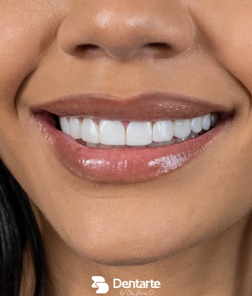 Diseño de sonrisa en Emporio Dentarte